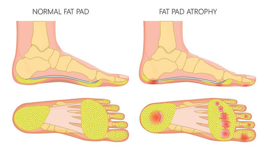 Why Your Feet Hurt More Lately — And What to Do If You Have High Arches or Fat Pad Loss